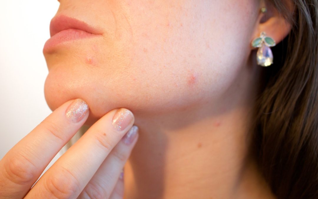 5 Treatments For Acne Scars