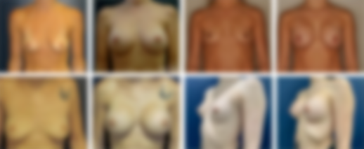 Breast Before and After images