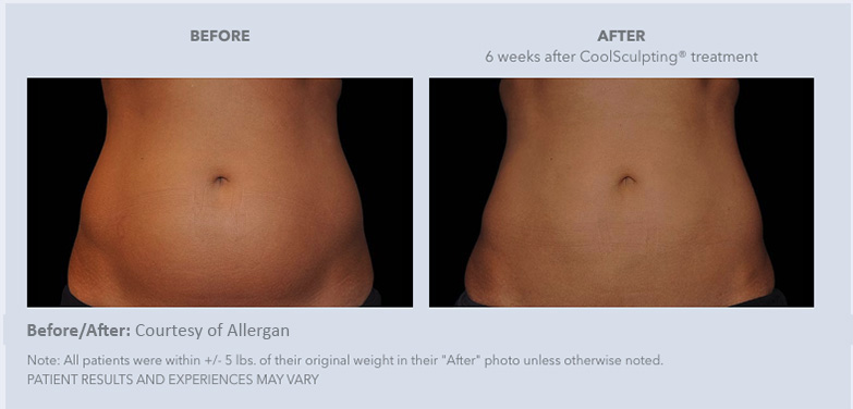 Real female patients of CoolSculpting from Gulf Coast Plastic Surgery