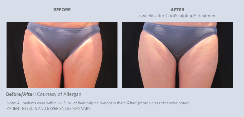 Real female patients of CoolSculpting from Gulf Coast Plastic Surgery