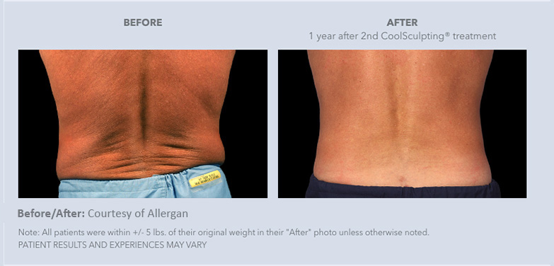 Real male patients of CoolSculpting from Gulf Coast Plastic Surgery