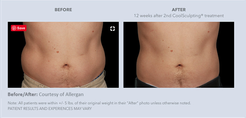 Real male patients of CoolSculpting from Gulf Coast Plastic Surgery