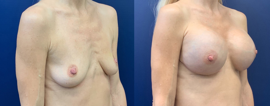 Breast Reconstruction Before and After Photo by Dr. Butler of Gulf Coast Plastic Surgery in Pensacola, FL