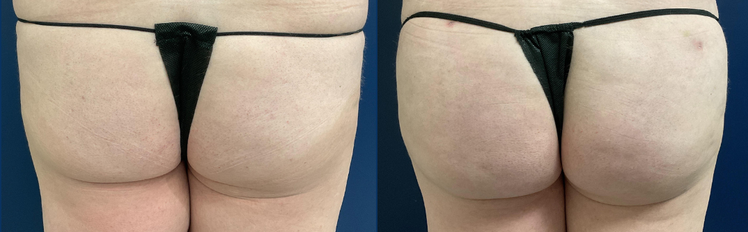 Brazilian Butt Lift Before and After Photo by Dr. Leveque of Gulf Coast Plastic Surgery in Pensacola, FL