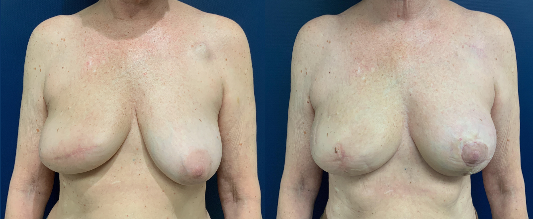 Breast Reconstruction Before and After Photo by Dr. Patterson of Gulf Coast Plastic Surgery in Pensacola, FL