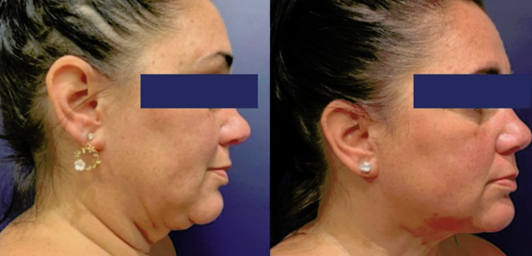 Chin Liposuction by Dr. Patterson