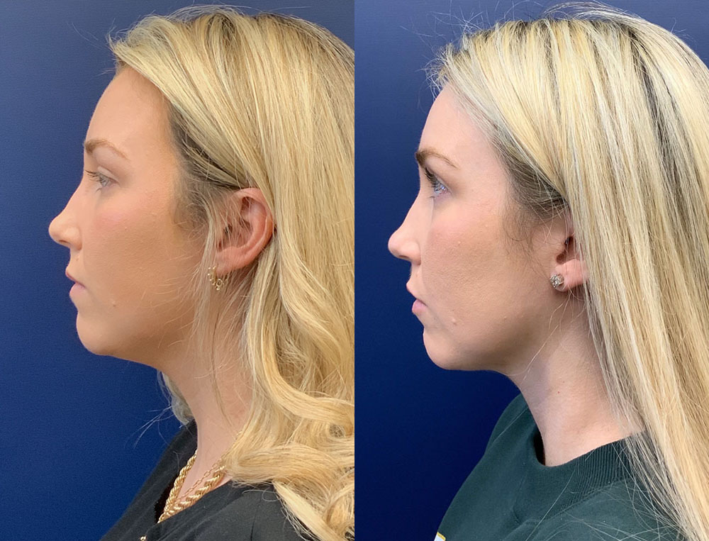 Liposuction of the Neck by Dr. Butler in Pensacola Florida