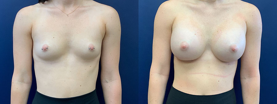 Before & After Breast Augmentation Mastopexy by Dr. Butler in Pensacola, Florida