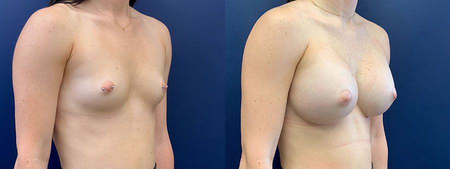 Before & After Breast Augmentation Mastopexy by Dr. Butler in Pensacola, Florida