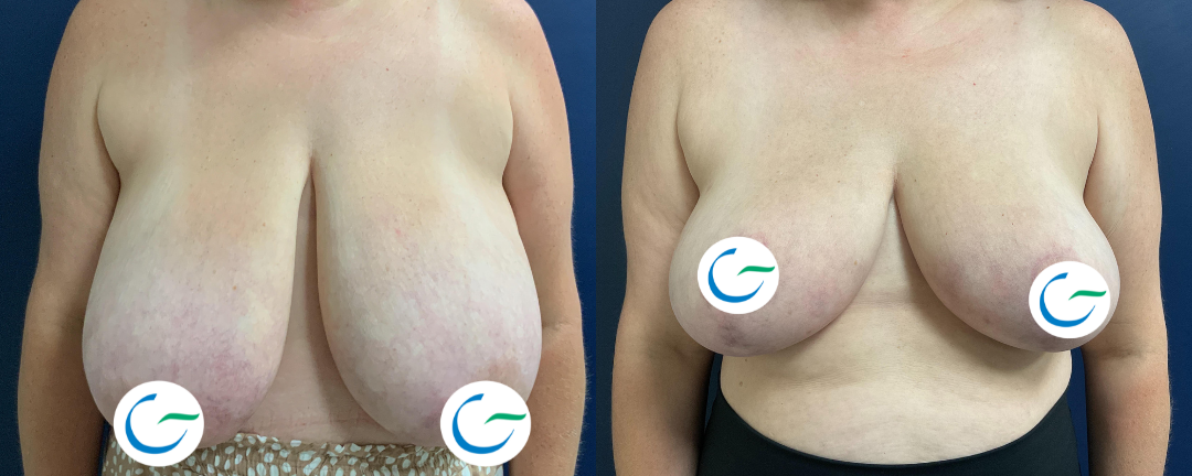 Breast Reduction Before and After Photo by Dr. Leveque in Pensacola Florida