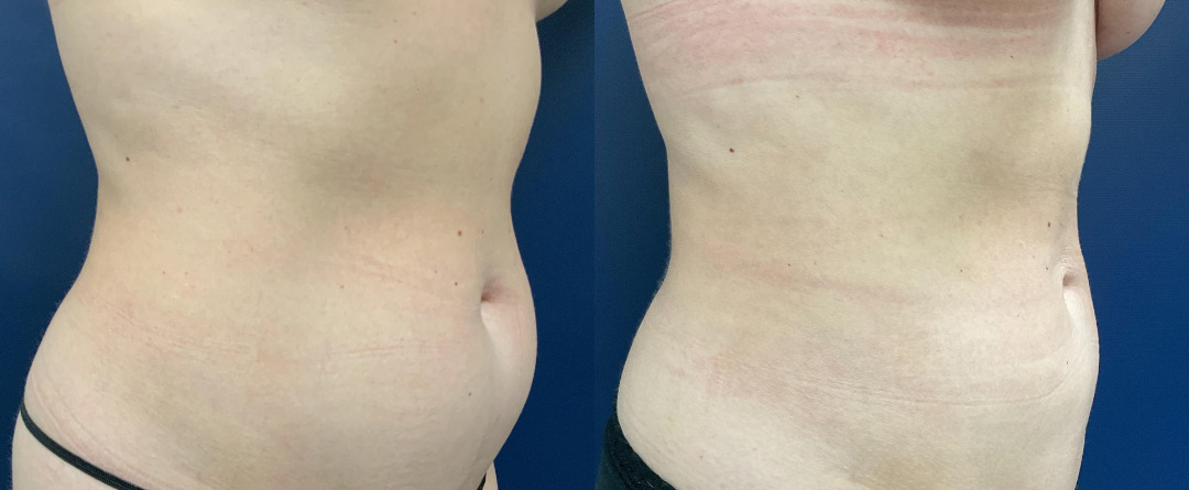 Liposuction Before and After Photo by Dr. Leveque in Pensacola Florida