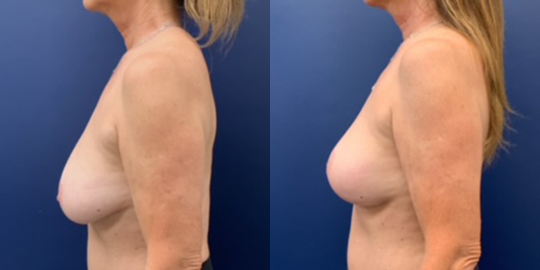 Before & After Breast Lift by Dr. Butler