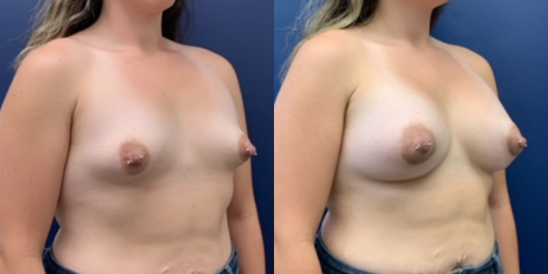 Before & After Breast Augmentation with Lift by Dr. Butler