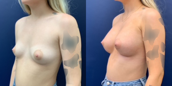 Before & After Breast Augmentation with Lift by Dr. Butler