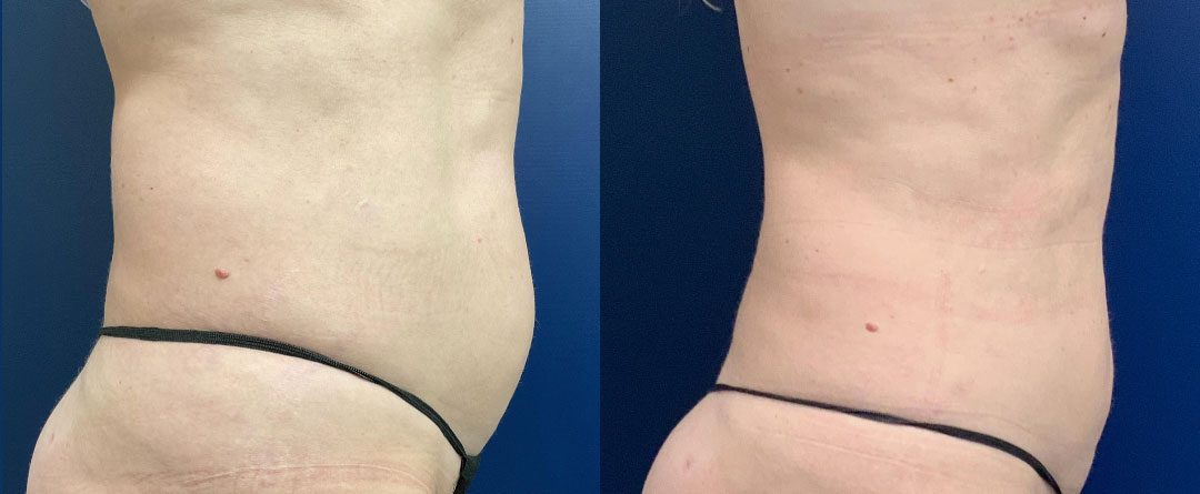 Liposuction of the abdomen Before and After Photo by Dr. Leveque of Gulf Coast Plastic Surgery in Pensacola, FL