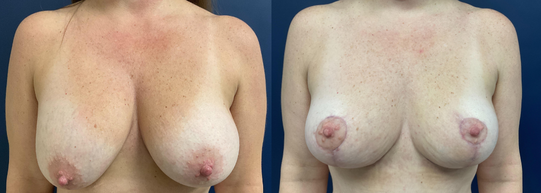 Breast Lift Before and After Photo by Dr. Leveque in Pensacola Florida