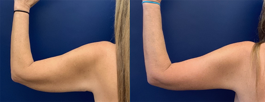 Arm Lift/Brachioplasty Before and After Photo by Dr. Butler in Pensacola Florida