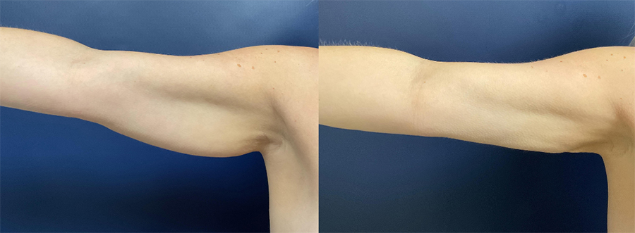 Liposuction of the Arms Before and After Photo by Dr. Leveque of Gulf Coast Plastic Surgery in Pensacola, FL