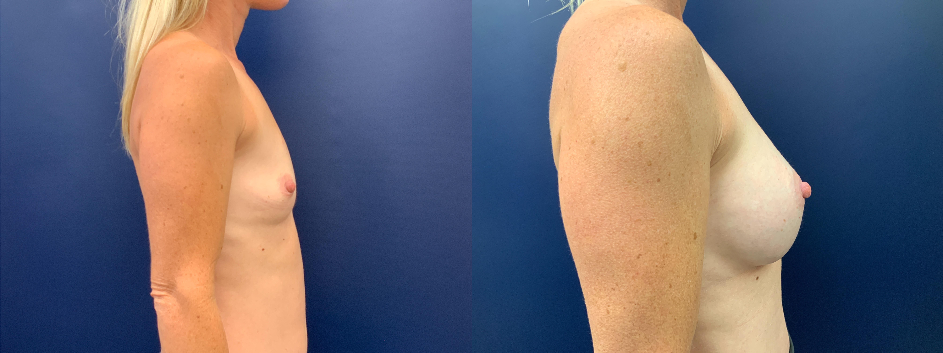 Breast Augmentation Before and After Photo by Dr.Butler in Pensacola Florida
