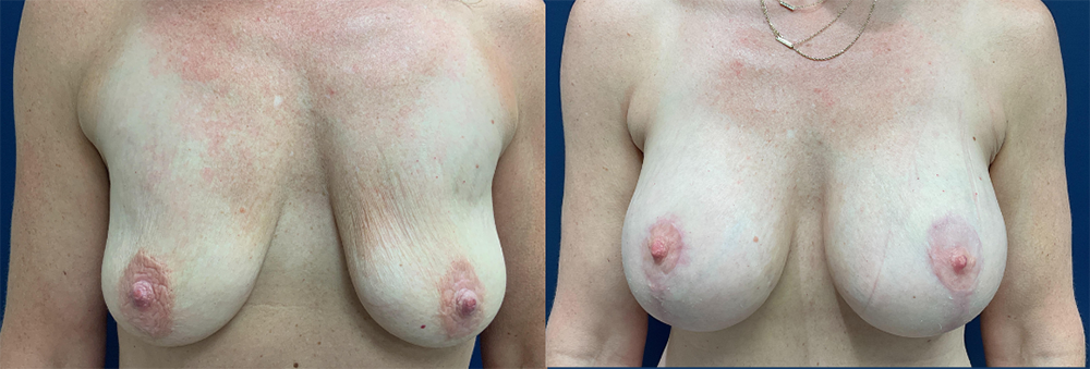 Breast Augmentation with Lift Before and After Photo by Dr. Leveque in Pensacola Florida