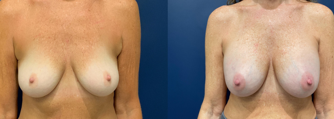 Breast augmentation done on a 61-year-old female patient, by Dr. Patterson