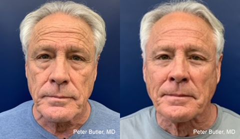 Blepharoplasty Before and After Photo by Dr. Butler in Pensacola Florida