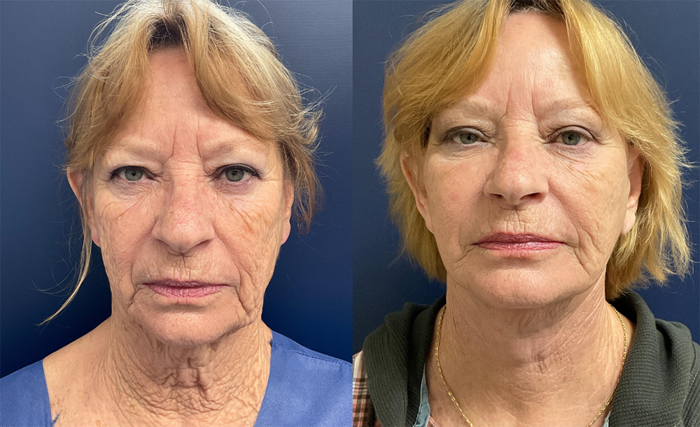 Facelift Before and After Photo by Dr. Leveque of Gulf Coast Plastic Surgery in Pensacola Florida