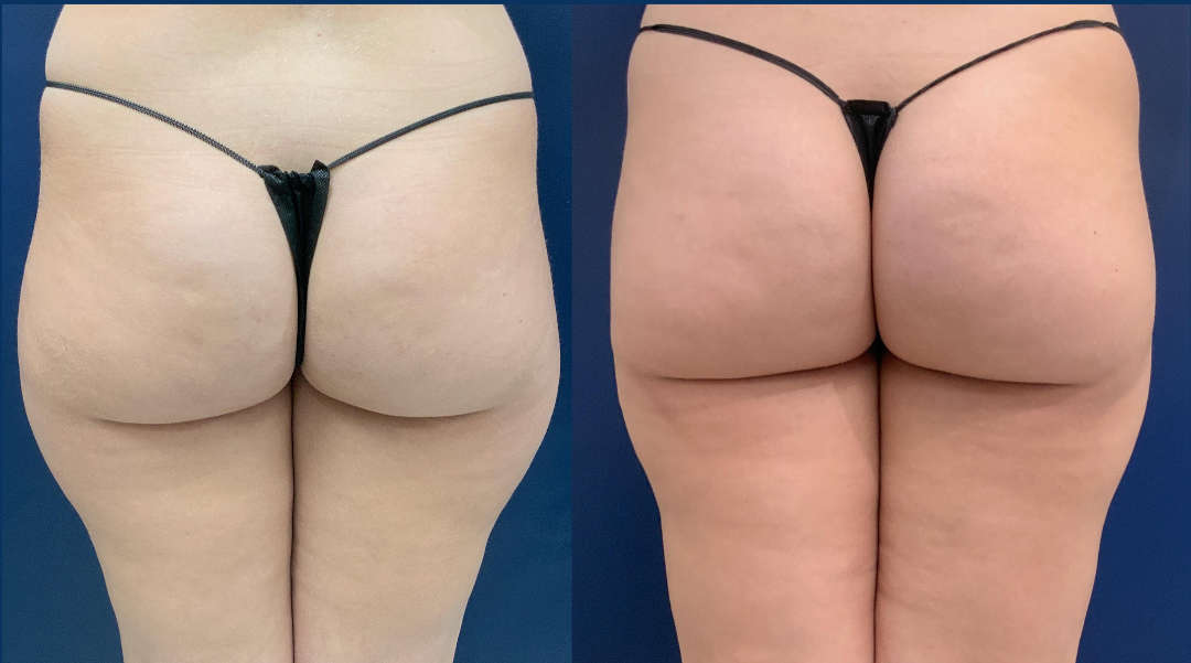 Liposuction Before and After Photo by Dr. Patterson of Gulf Coast Plastic Surgery in Pensacola Florida