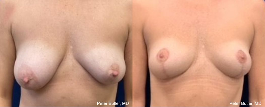 Breast Lift Before and After Photo by Dr. Butler of Gulf Coast Plastic Surgery in Pensacola, FL