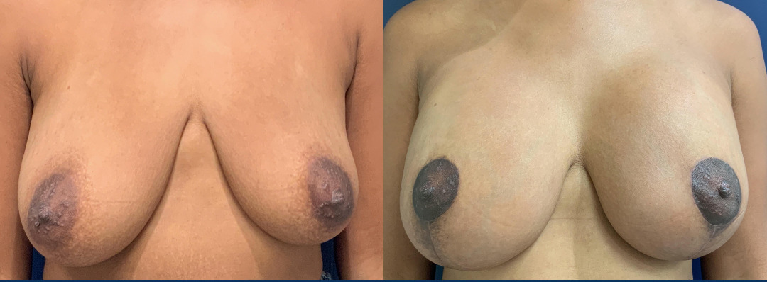 Breast Reduction Before and After Photo by Dr. Patterson of Gulf Coast Plastic Surgery in Pensacola, FL