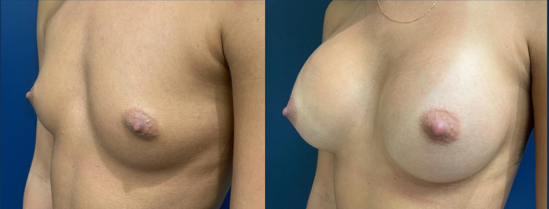 Breast Augmentation Before and After Photo by Dr. Patterson of Gulf Coast Plastic Surgery in Pensacola, FL
