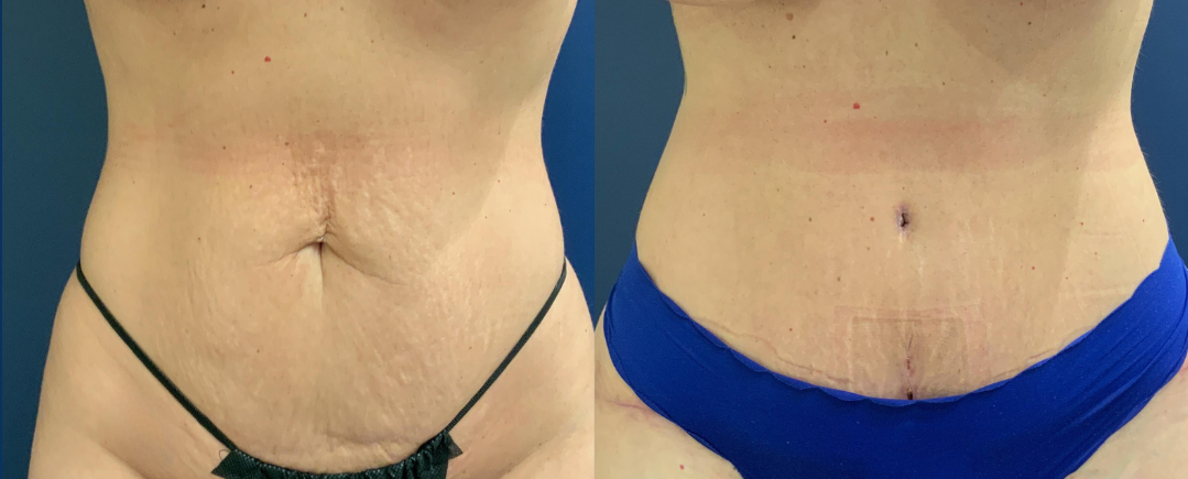 Tummy Tuck Before and After Photo by Dr. Patterson of Gulf Coast Plastic Surgery in Pensacola, FL