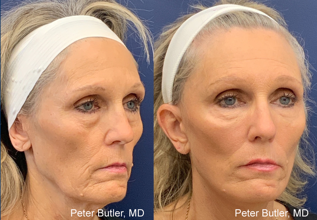 Facelift & Brow Lift Before and After Photo by Dr. Butler of Gulf Coast Plastic Surgery in Pensacola Florida