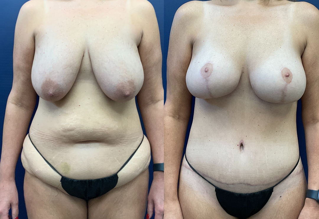 Tummy Tuck/Mastopexy/Liposuction Before and After Photo by Dr. Butler of Gulf Coast Plastic Surgery in Pensacola Florida