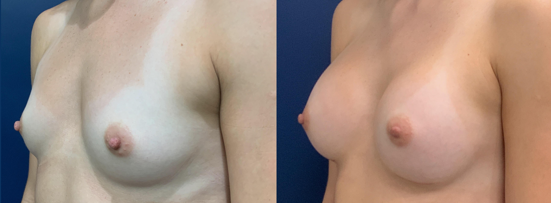 Breast Augmentation Before and After Photo by Dr. Patterson of Gulf Coast Plastic Surgery in Pensacola Florida