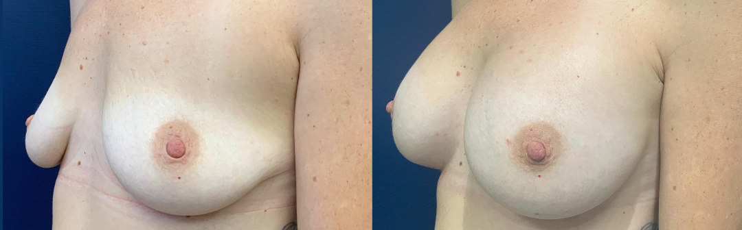 Breast Augmentation Before and After Photo by Dr. Patterson of Gulf Coast Plastic Surgery in Pensacola Florida