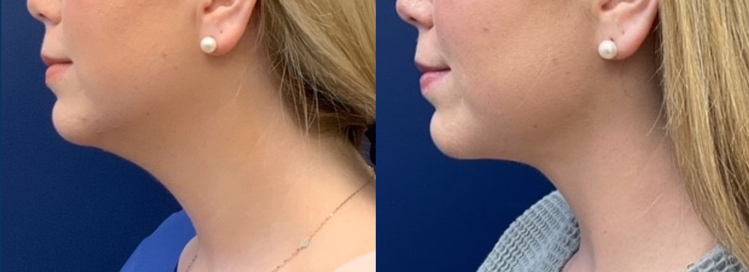 Neck Liposuction Before and After Photo by Dr. Butler of Gulf Coast Plastic Surgery in Pensacola Florida