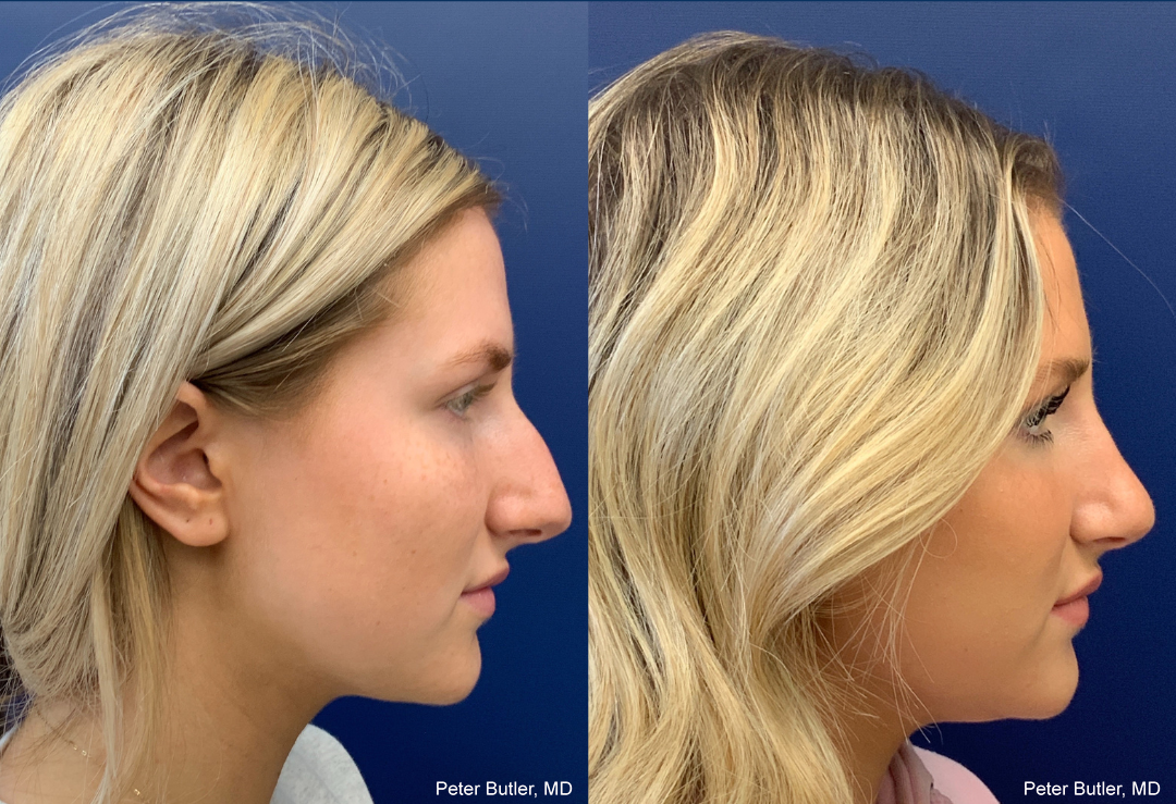 Rhinoplasty Before and After Photo by Dr. Butler of Gulf Coast Plastic Surgery in Pensacola Florida