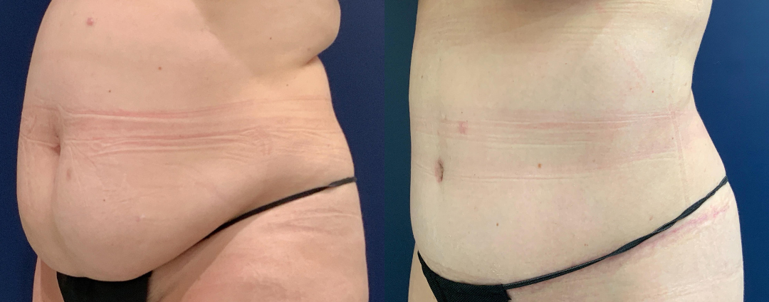 Tummy Tuck Before and After Photo by Dr. Patterson of Gulf Coast Plastic Surgery in Pensacola Florida