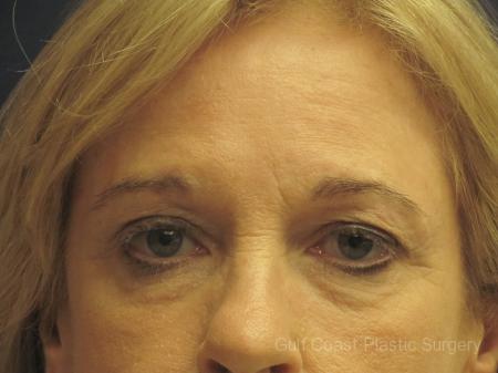Upper Eyelid Surgery Performed By Dr. Leveque
