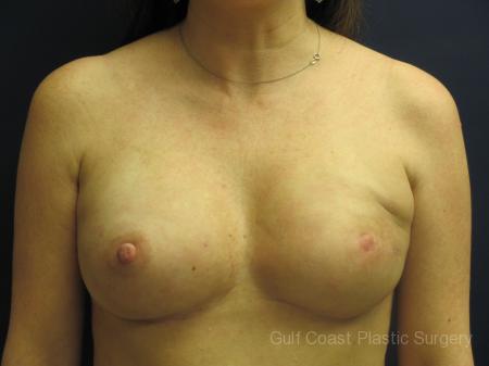 Breast Reconstruction By Dr Leveque