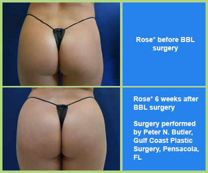 BBL before and after performed by Dr. Butler