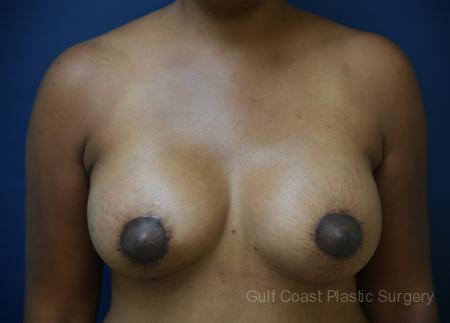 Breast Augmentation Gallery by Dr. Leveque