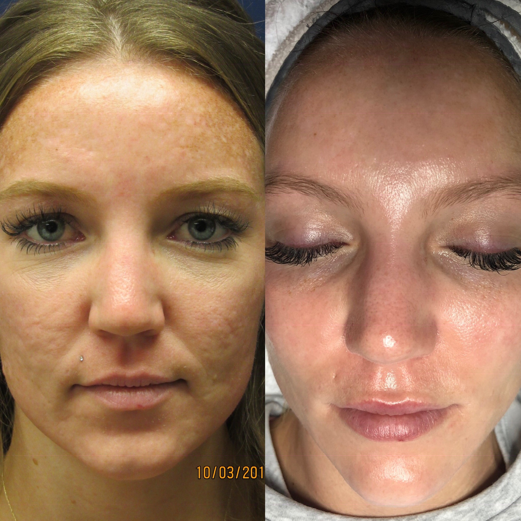 Microneedling For Acne Scars Gulf Coast Plastic Surgery