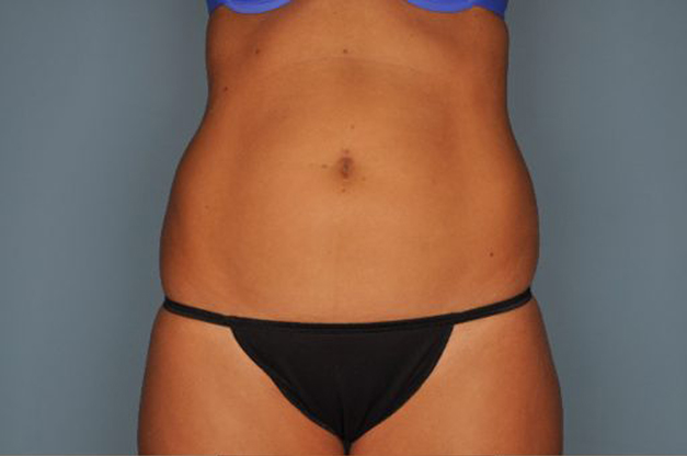 Liposuction By Dr. Patterson