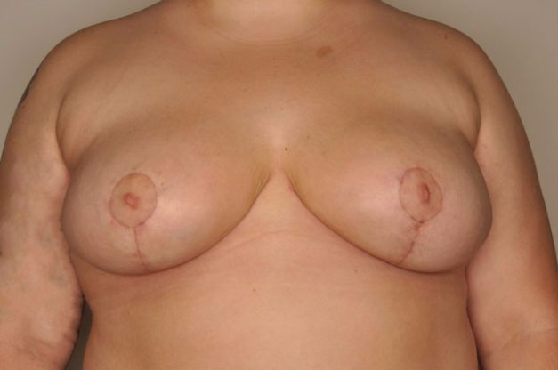 Breast Reduction by Dr. Patterson